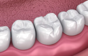 Laser Cavity Repair for Painless Dental Fillings